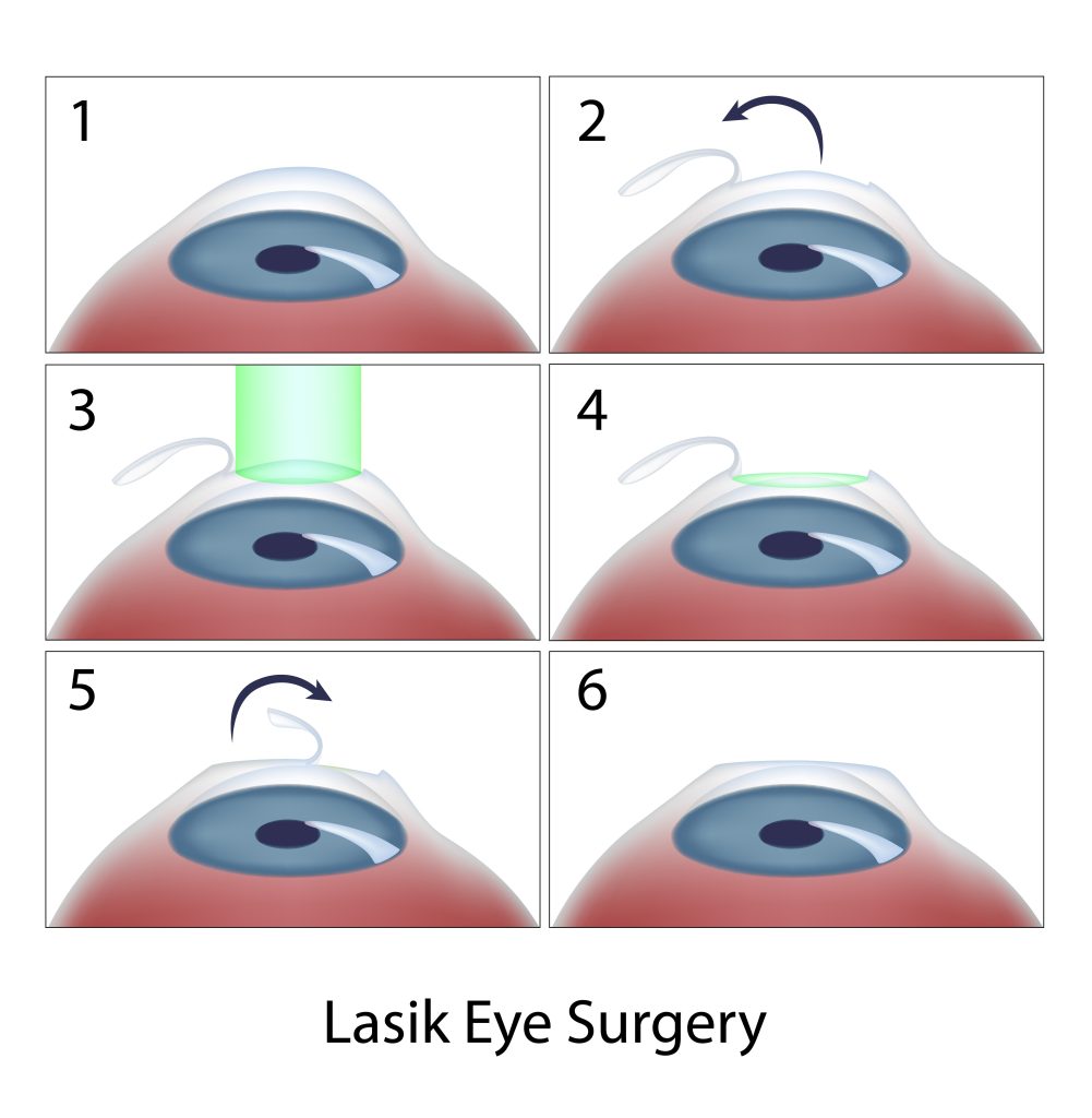 Mổ mắt cận thị LASIK (laser)
